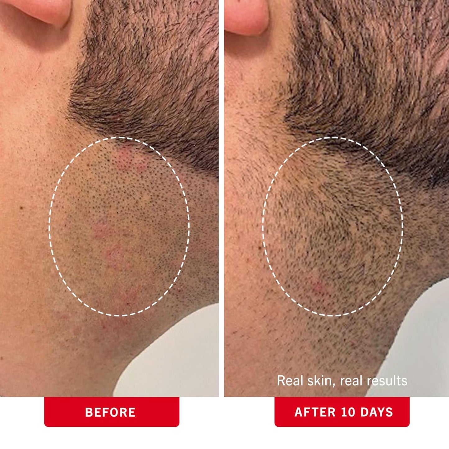 First Aid Beauty - Ingrown Hair Pads with BHA + AHA - Aftershave Treatment Pads Help Men & Women Prevent Razor Bumps, Exfoliate Underarms & Bikini Area, Compostable for Daily Use - 3ct, 84 Pads Total